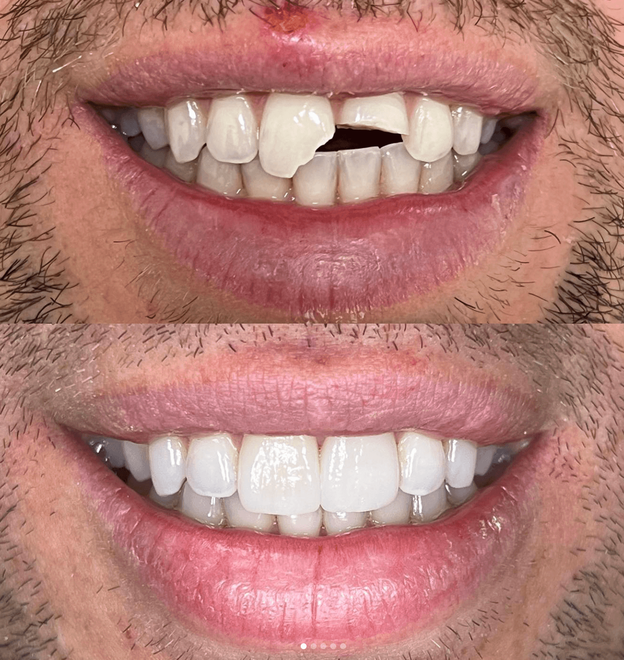 Chipped Teeth Repair