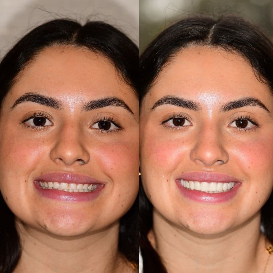 Gum Lift & Smile Makeover