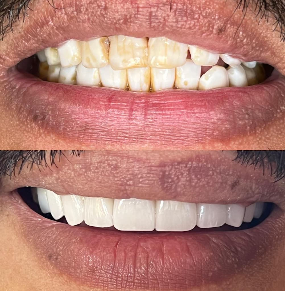 Porcelain Veneers & Cosmetic Restoration