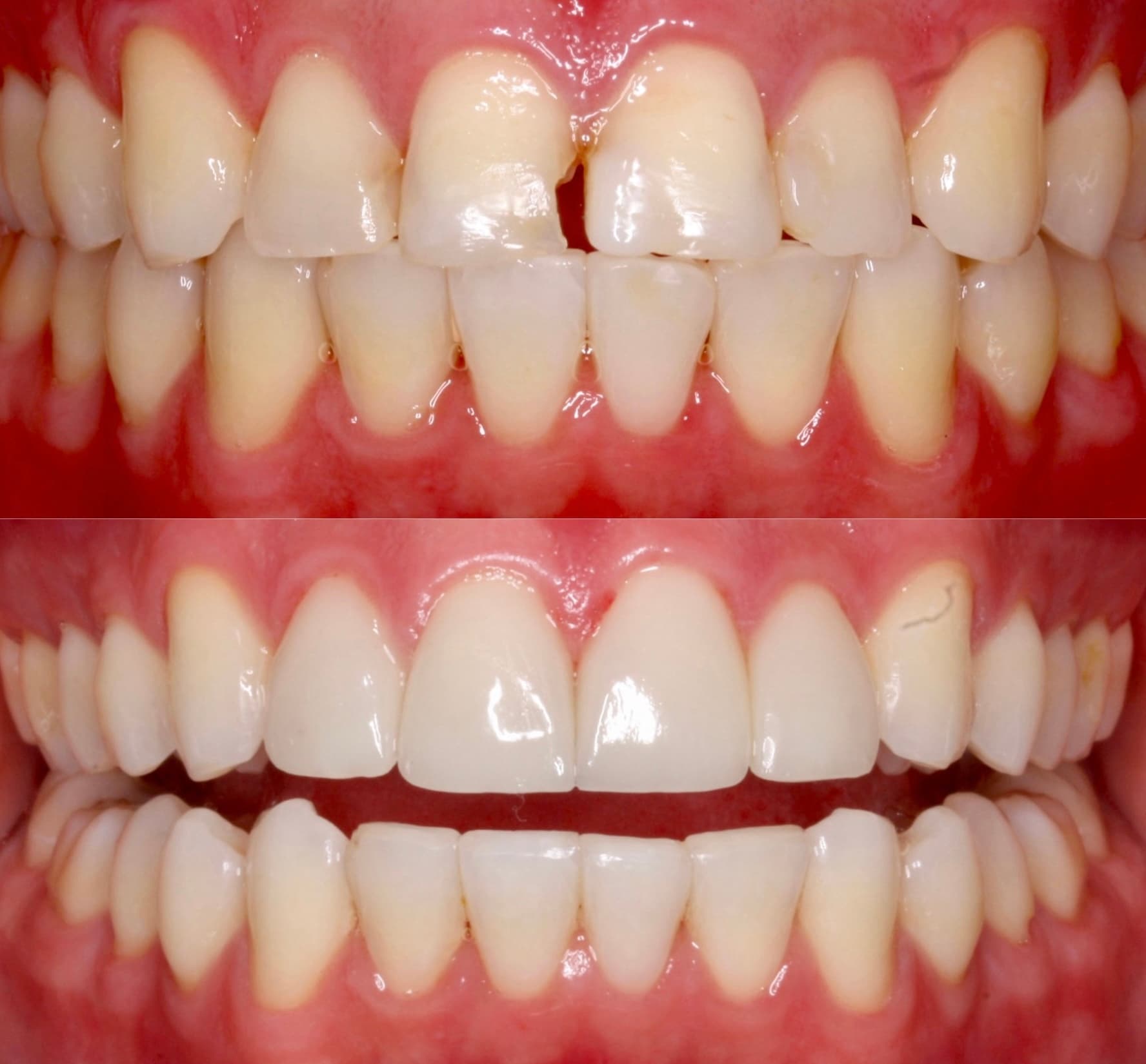 Front Four Veneer Enhancement