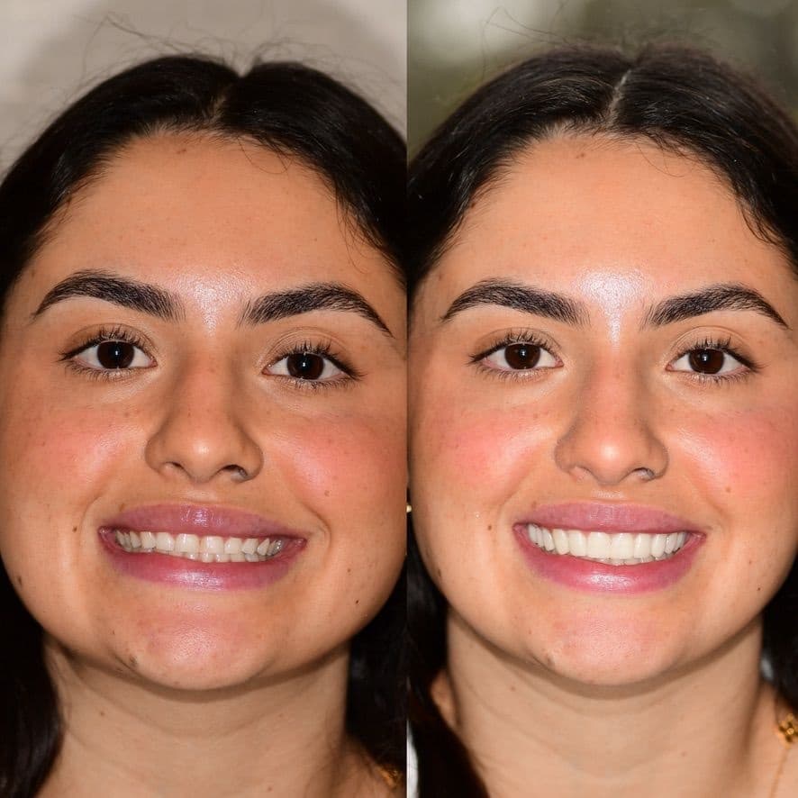 Smile Makeover