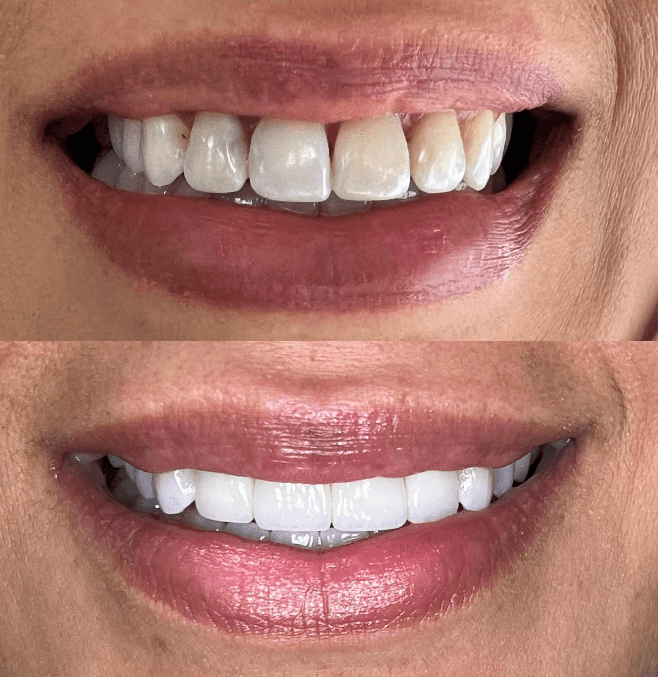 Smile Veneers