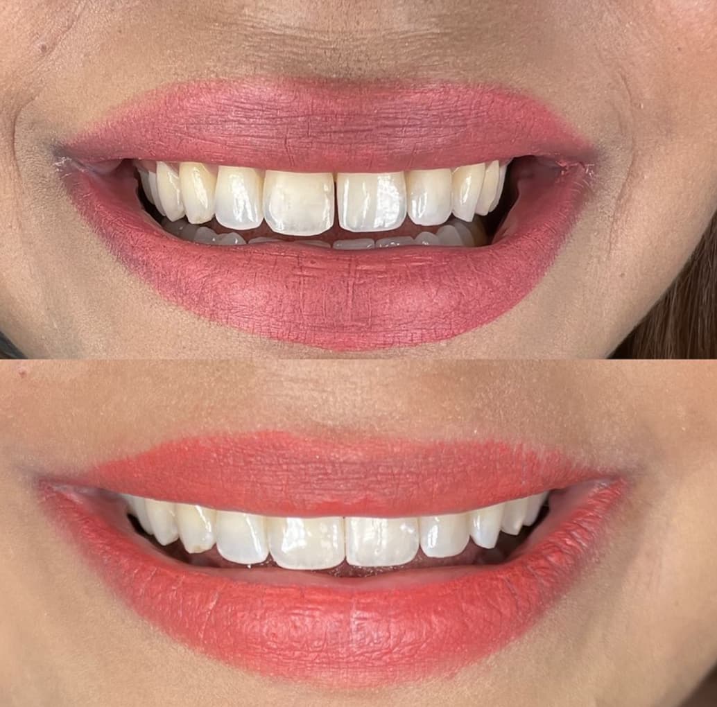 Minimal Prep Veneers