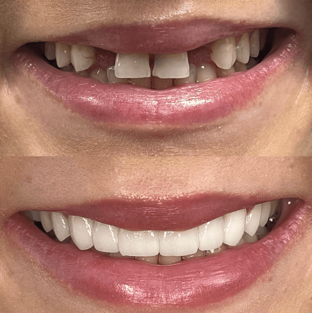 Missing Tooth Restoration