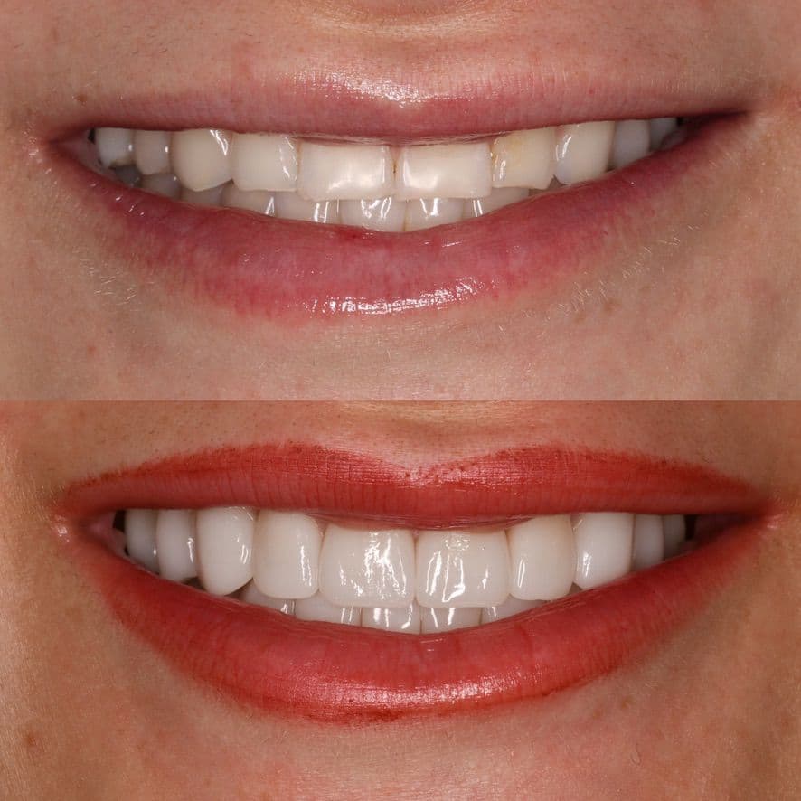 Natural Aesthetic Veneers