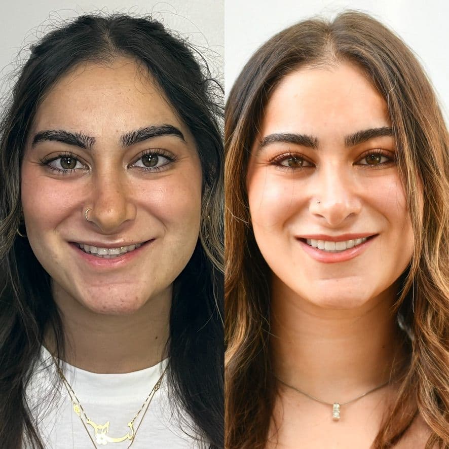 Reconstructive Veneers