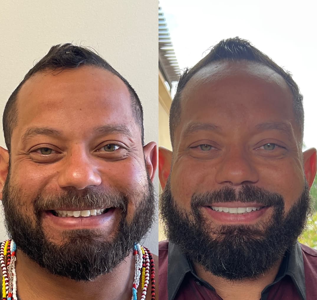 Smile Makeover Transformation