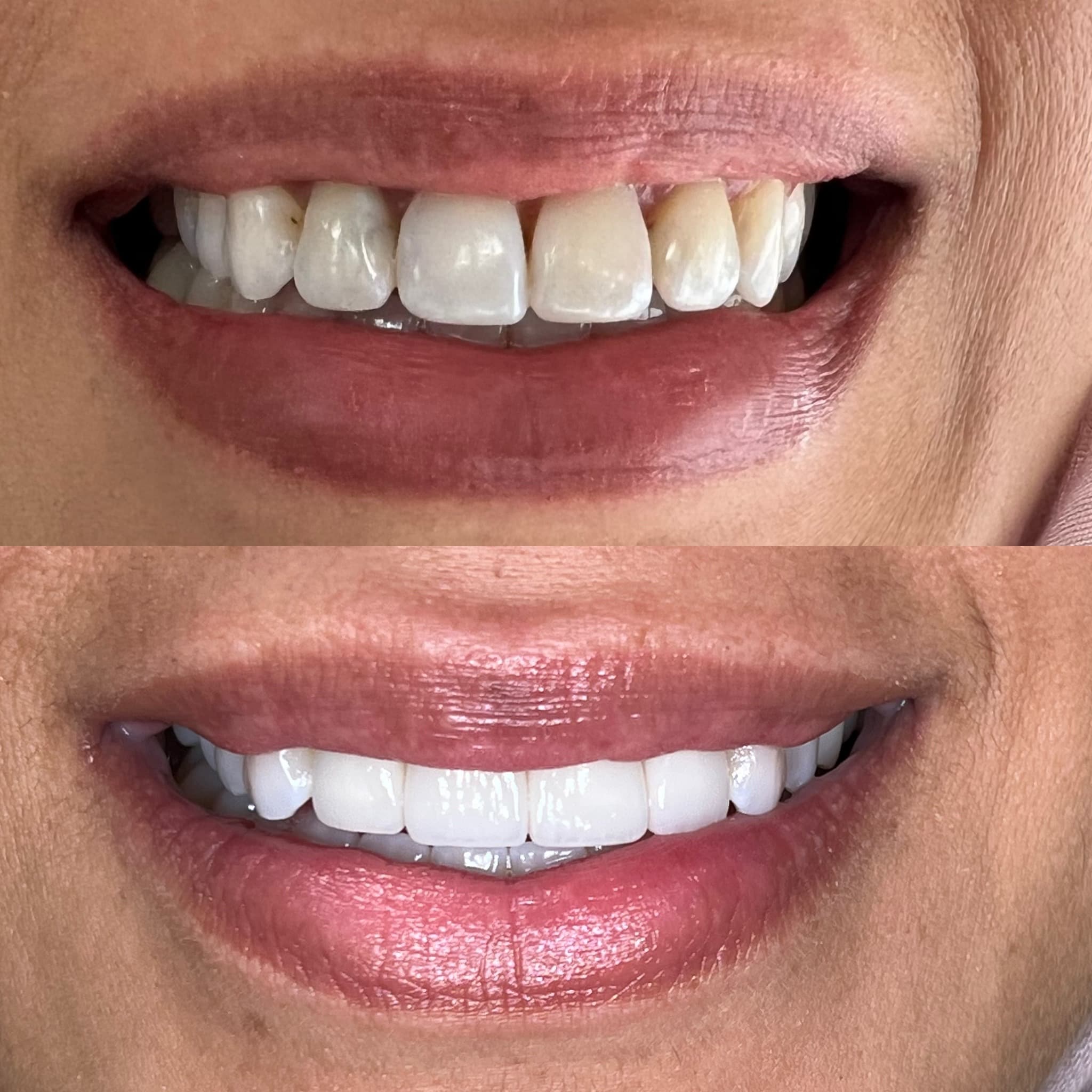 Natural Smile Enhancement