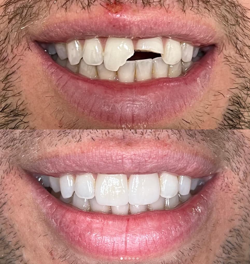 Veneers & Whitening Combination