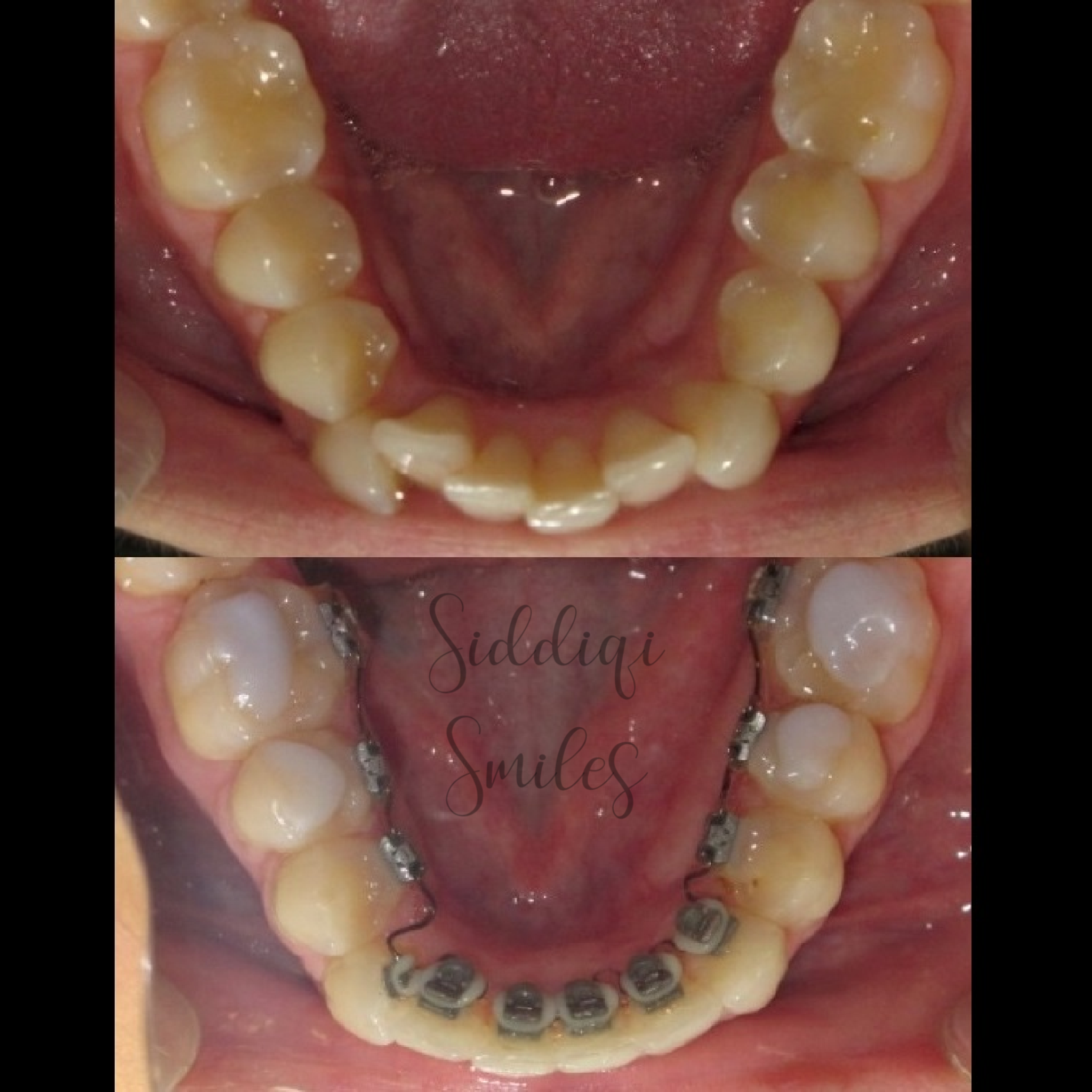 Hidden Braces with InSmile