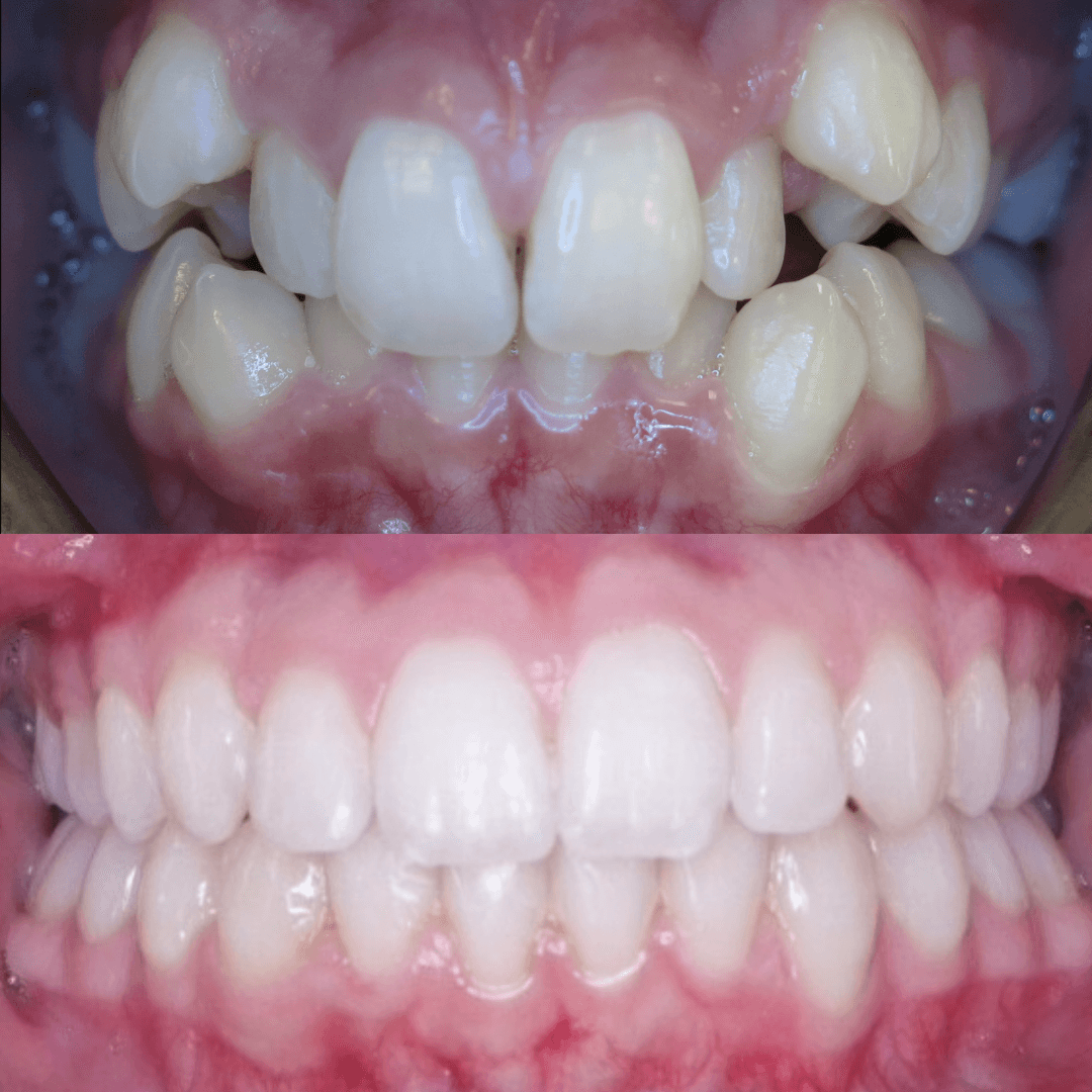 Traditional Metal Braces