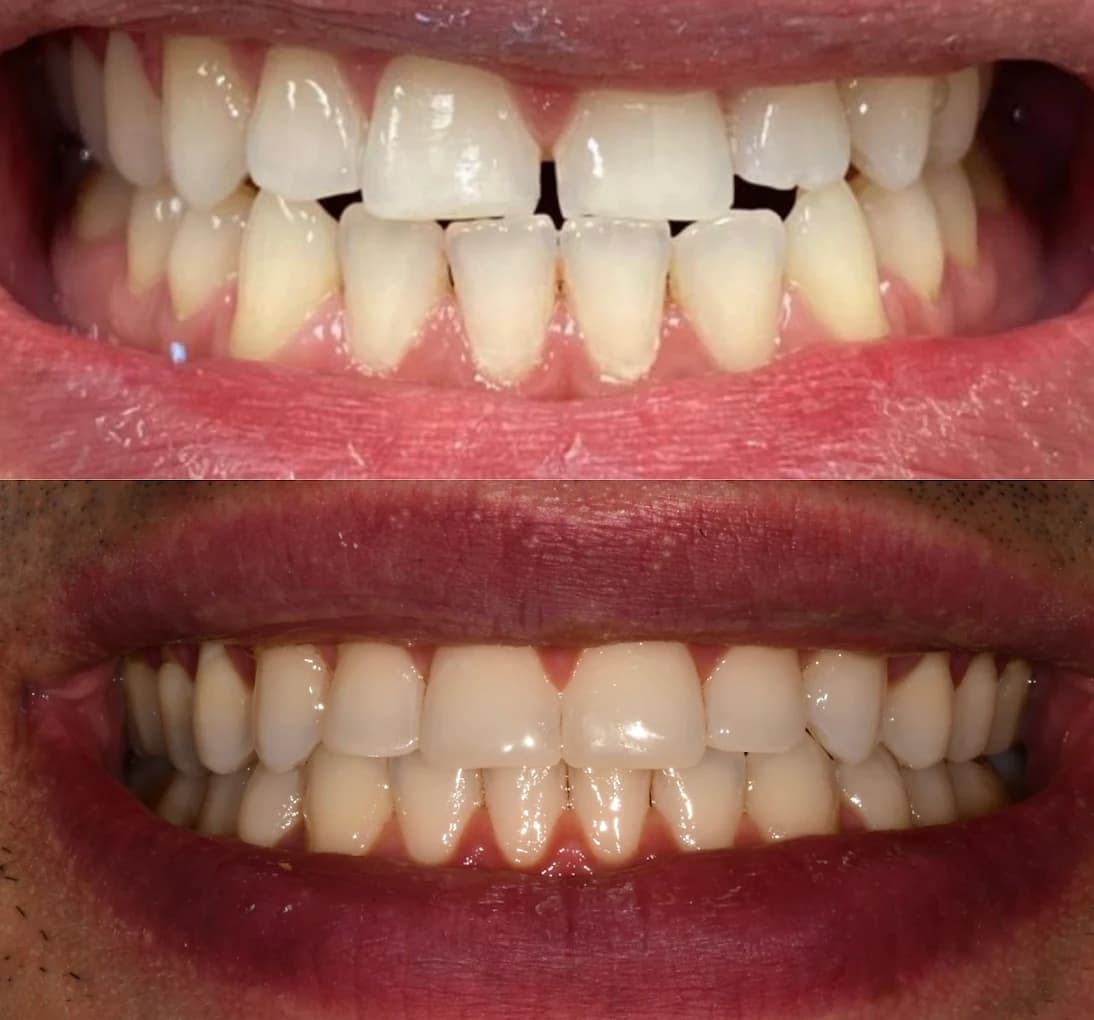 Invisalign & Bonding