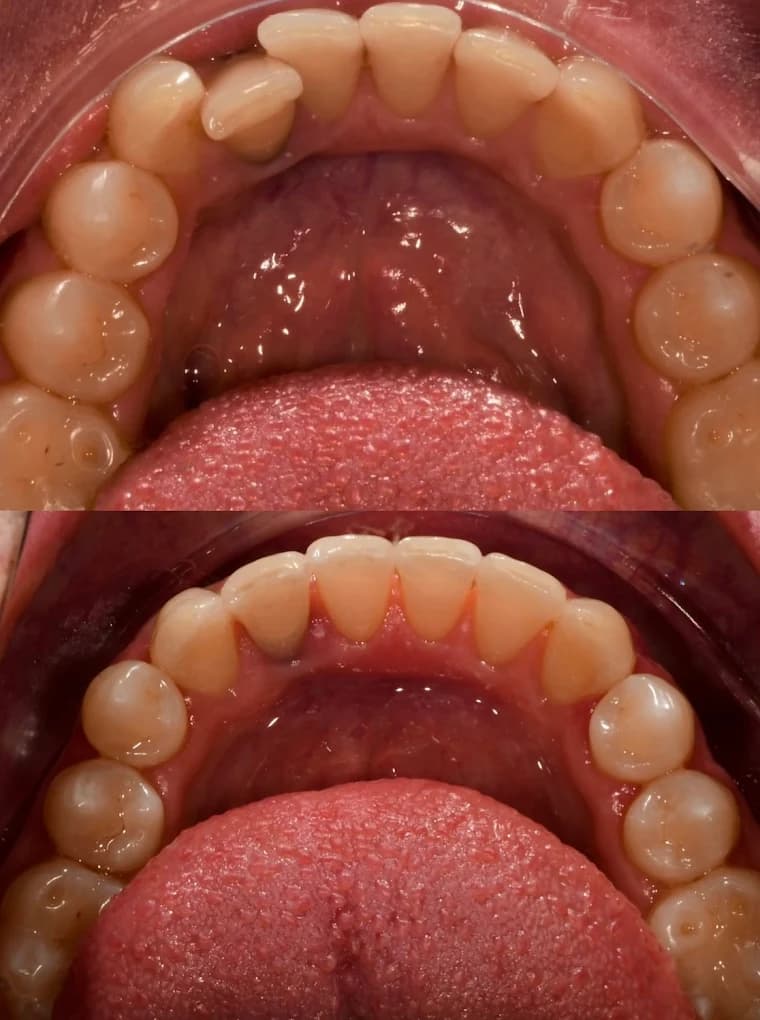 Invisalign Before & After