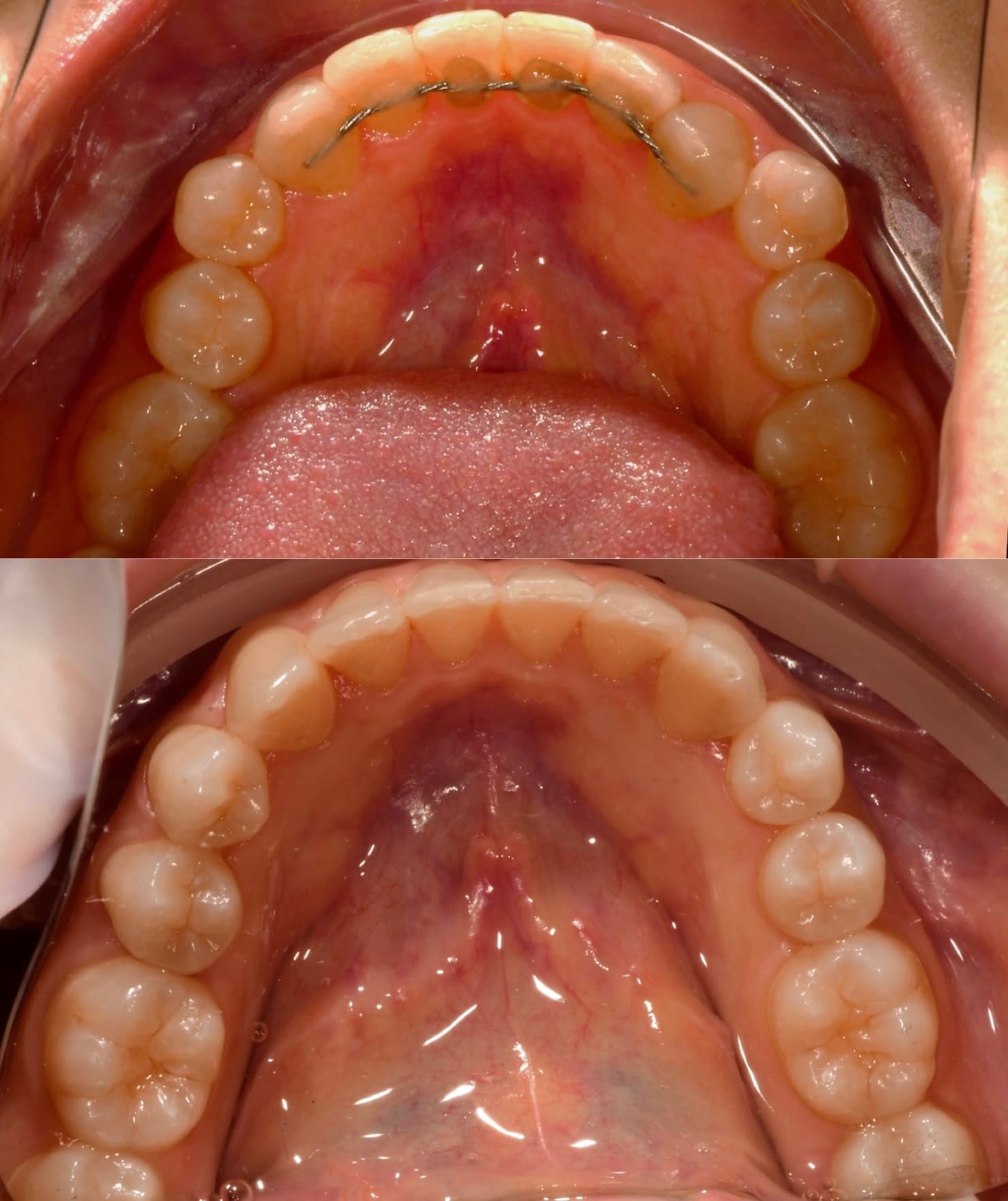 Invisalign Clear Aligner Therapy