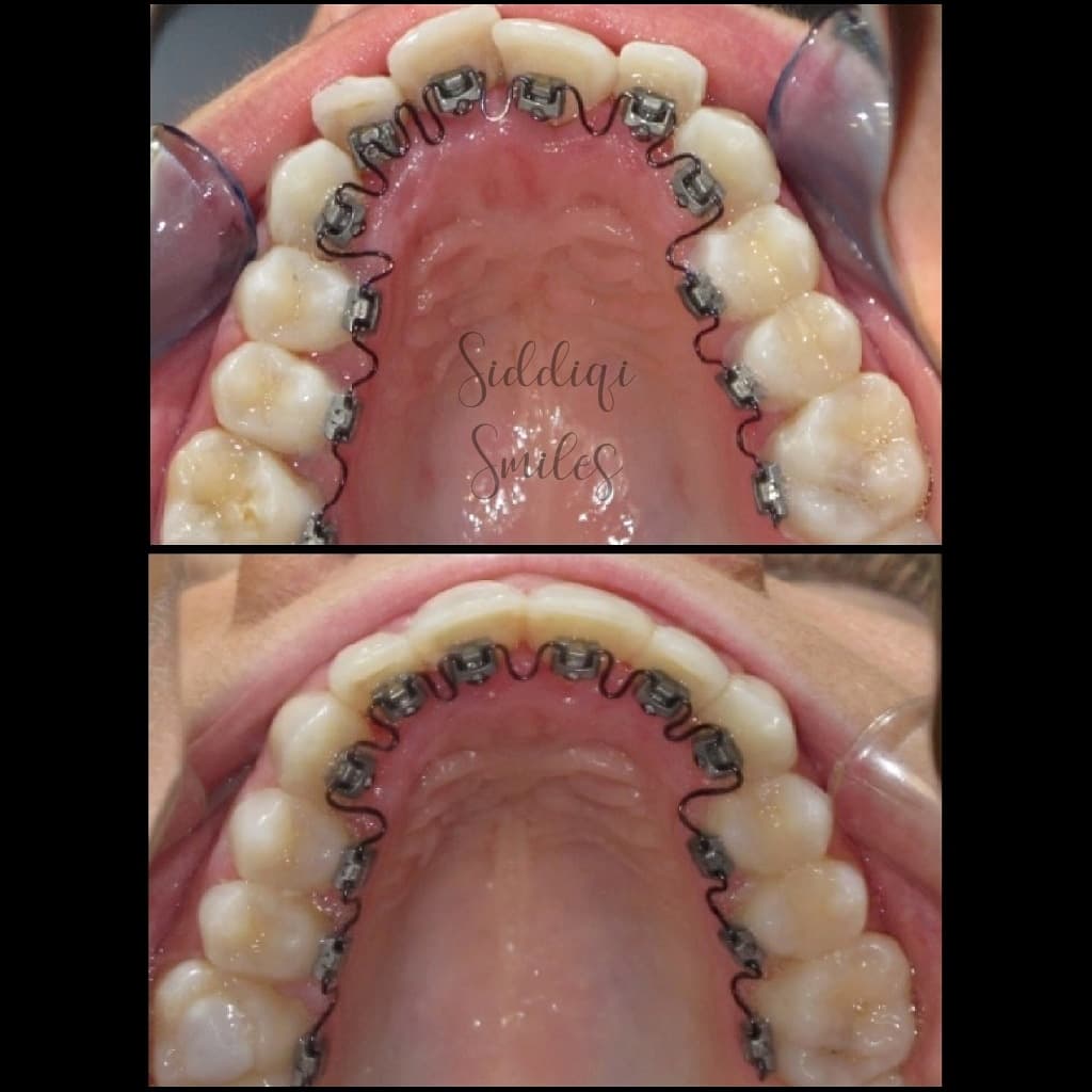 InSmile Lingual Orthodontics