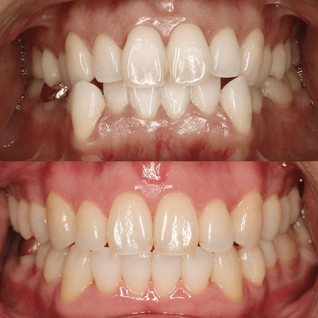 Comprehensive Braces Treatment