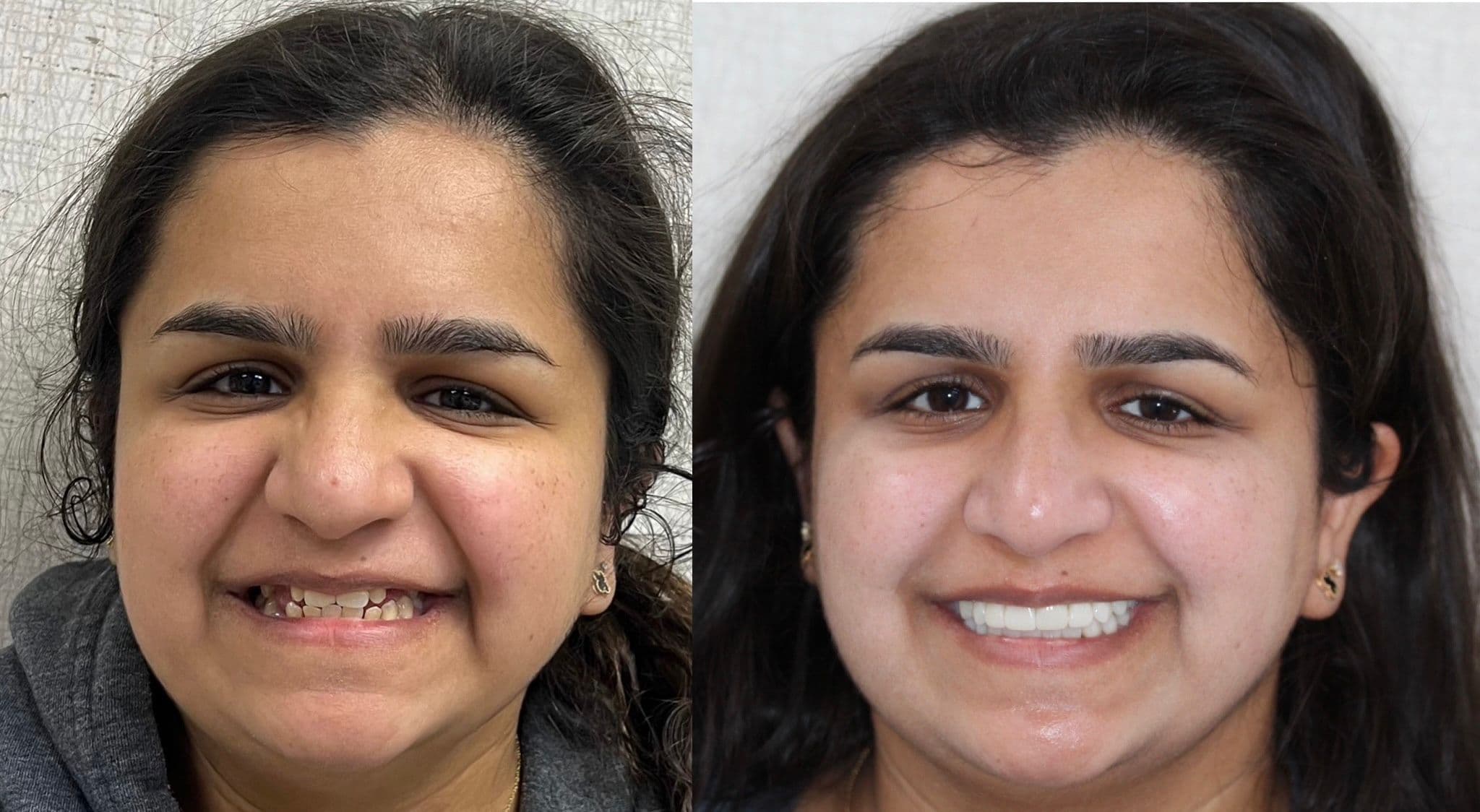 Complete Smile Reconstruction
