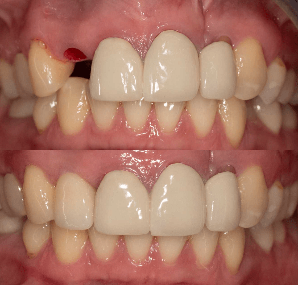 Dental Implant Restoration