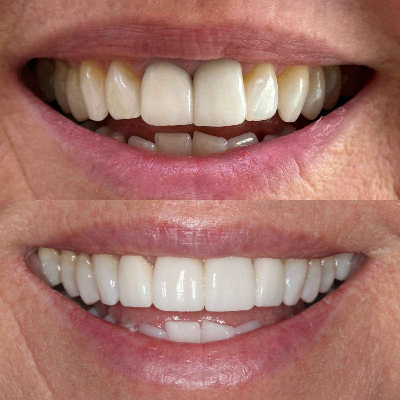 Veneers & Reconstruction