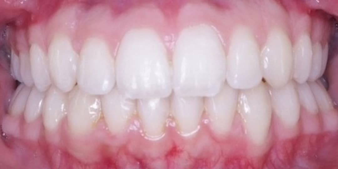 After: InSmile Smile Transformation